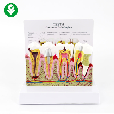 اللثة الأسنان الأسنان نموذج الإنسان الطبي تسوس الأمراض الشائعة العرض